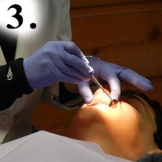 Удаление пораженных тканей, совмещенное с медикаментозной обработкой, в процессе лечения каналов зубов