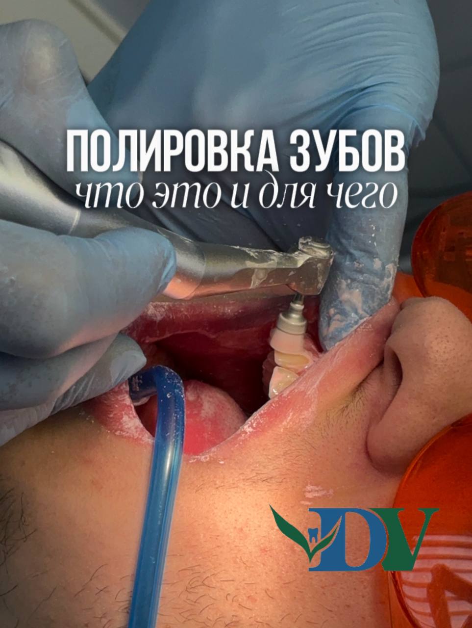 Полировка зубов